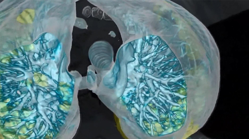 Kovid-19’un akciğerlerde bıraktığı hasarın iyileşmesi 12 hafta sürebiliyor