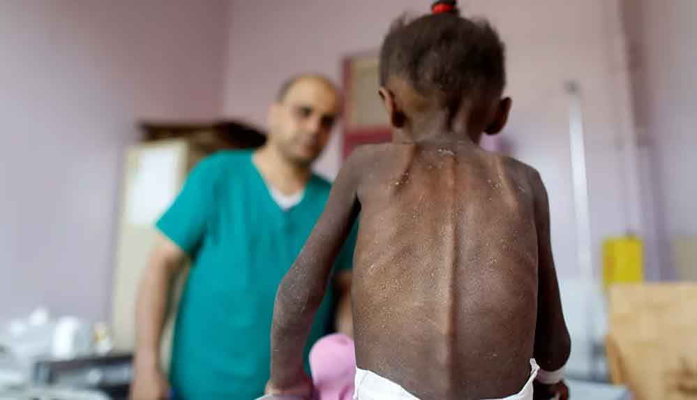 BM: Yemen'in güneyinde 98 bin çocuk yetersiz beslenmeden dolayı ölüm riskiyle karşı karşıya