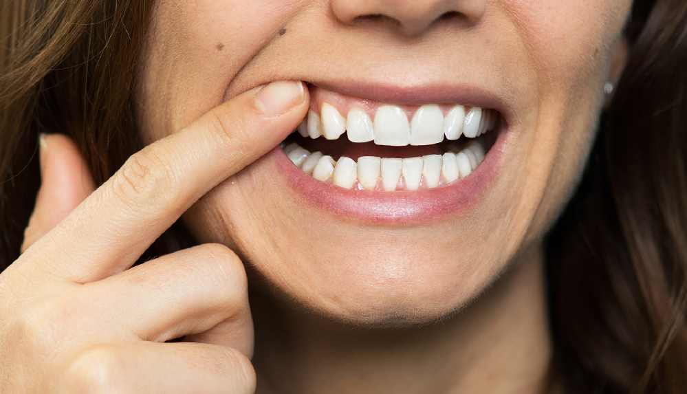 Diş eti kanaması neyin belirtisidir? 7 Diş eti kanaması neyin belirtisidir_