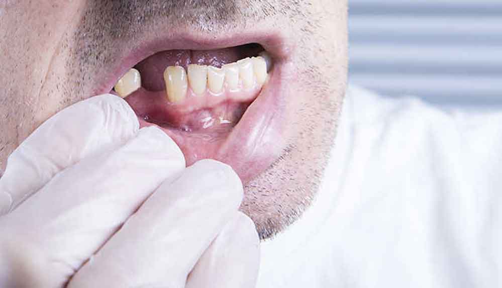 Kovid-19'un bir belirtisi daha ortaya çıktı: Kansız, acısız, aniden diş dökülmesi