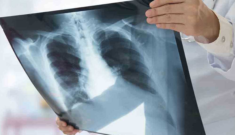 Uzman anlattı_ Zatürreden korunmanın yolları nelerdir_