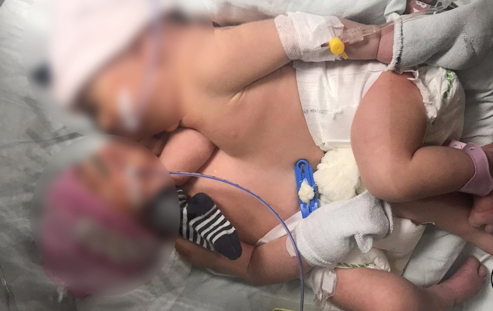 Cerrahpaşada'da 60 doktorun katılımıyla yapışık ikizler 11 saatte ayrıldı