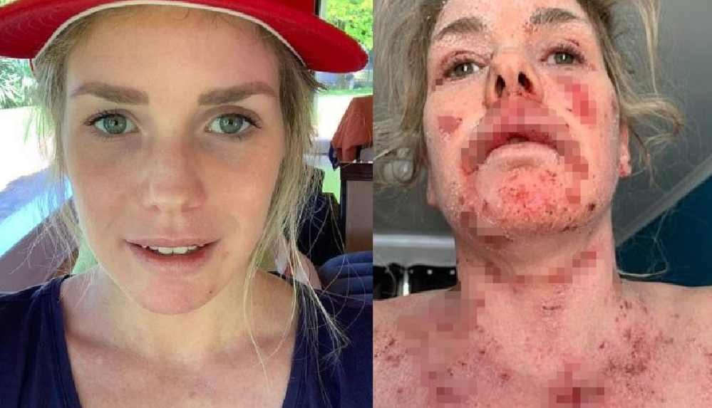 Egzama için krem aldı, hayatını şokunu yaşadı