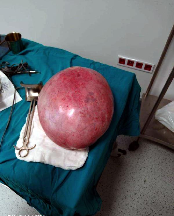 Karnından 9 kilo 800 gr kitle çıktı