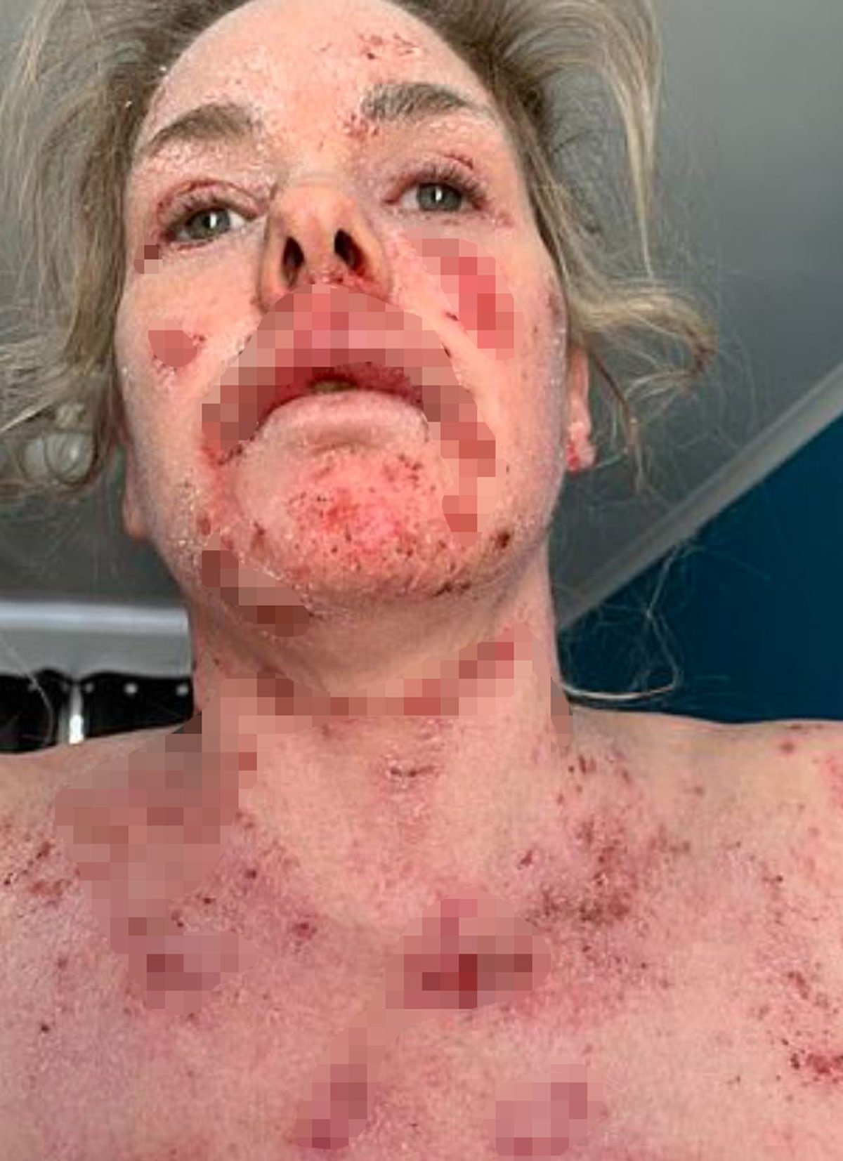 Egzama için krem aldı, hayatını şokunu yaşadı