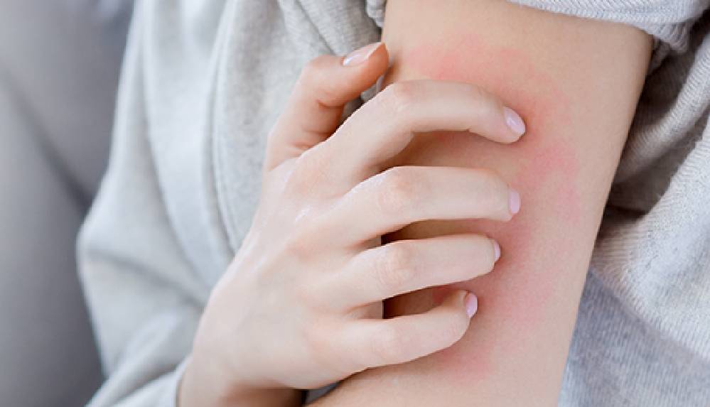 Uyuz hastalığı 15 dakikada bulaşıyor