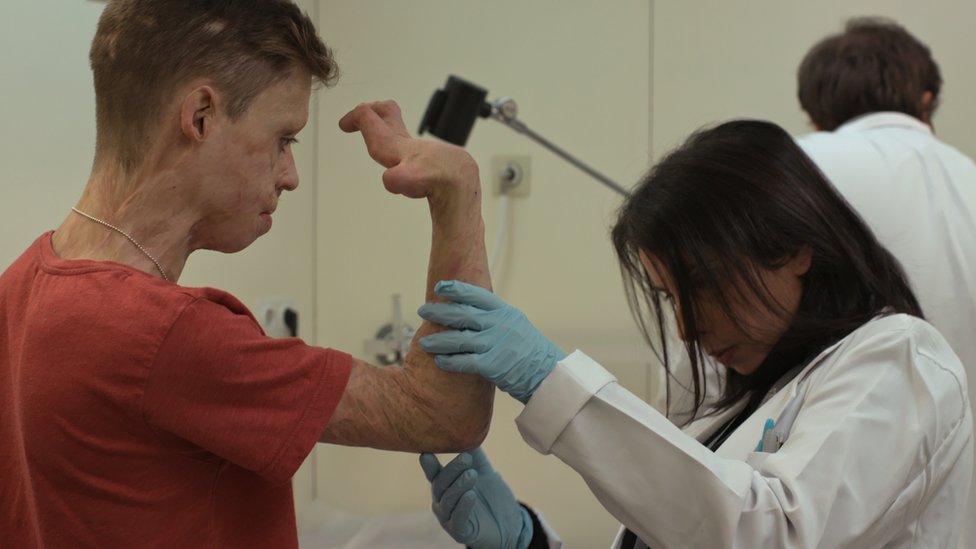 8 yaşında vücudunun yüzde 90'ı yandı