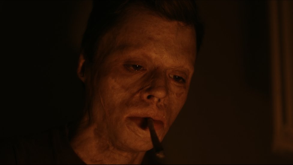 8 yaşında vücudunun yüzde 90'ı yandı