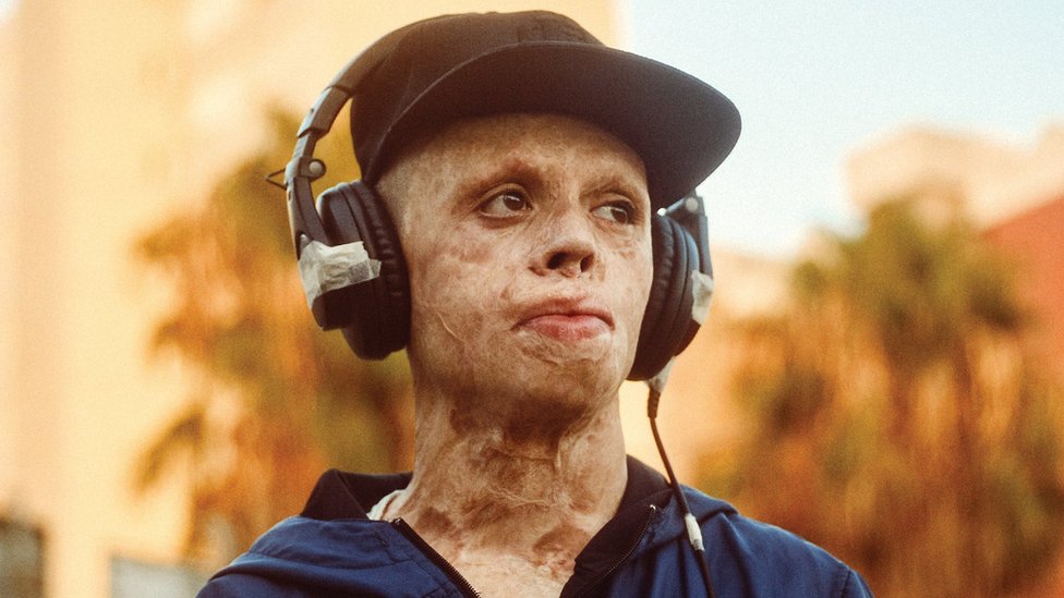 8 yaşında vücudunun yüzde 90'ı yandı