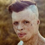 8 yaşında vücudunun yüzde 90'ı yandı 10 8 yaşında vücudunun yüzde 90'ı yandı