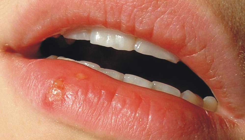 Bilim-insanları-açıkladı--Uçuk-neden-olur-