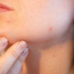 Bilime-göre-yüz-haritasında-sivilcenin-yeri-hangi-hastalığa-işaret-ediyor-