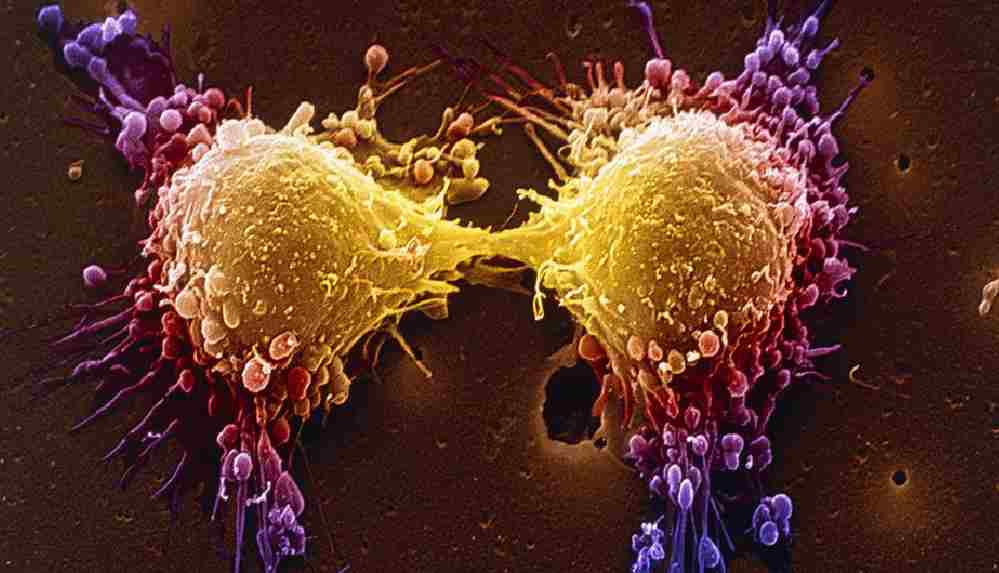 Covid salgını, kanserle mücadeleyi nasıl etkiledi_