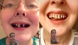 ABD’de 10 yıldır aşırı kola tüketen genç kadının dişleri döküldü
