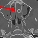 Kötü koku şikayetiyle doktora gitti_ Burnundan 8 yıllık mermi çıktı