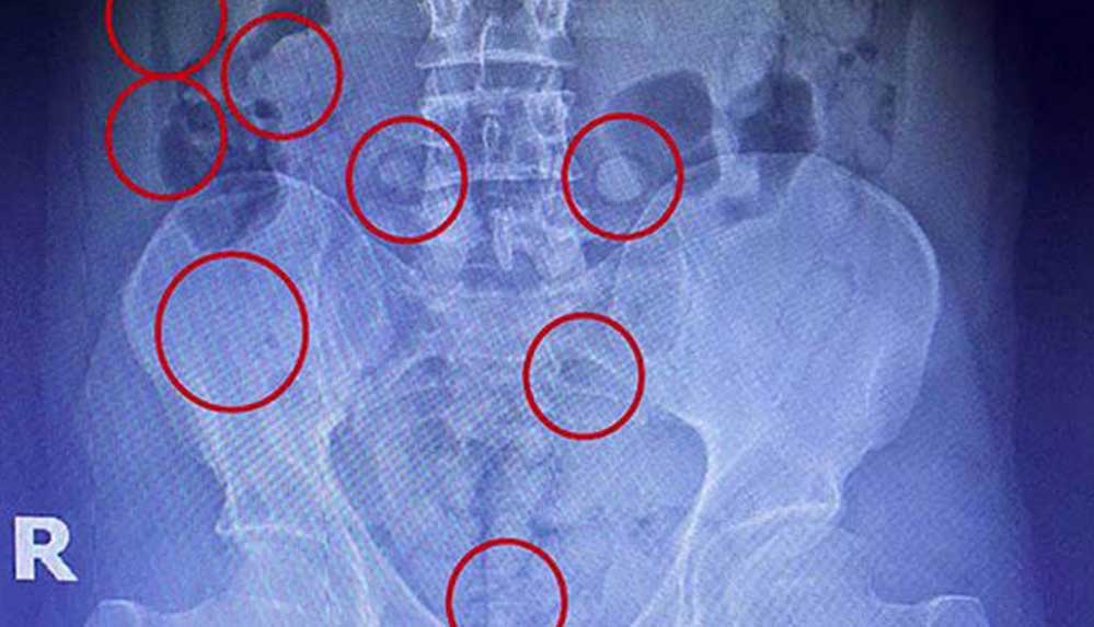 Mide ve bağırsağındaki uyuşturucu röntgenle ortaya çıktı 4 Mide-ve-bağırsağındaki-uyuşturucu-röntgenle-ortaya-çıktı