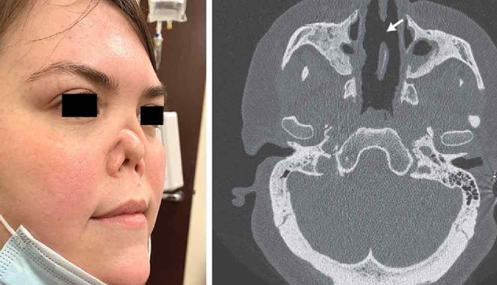 Nadir görülen hastalık, genç kadının burnunun çökmesiyle sonuçlandı