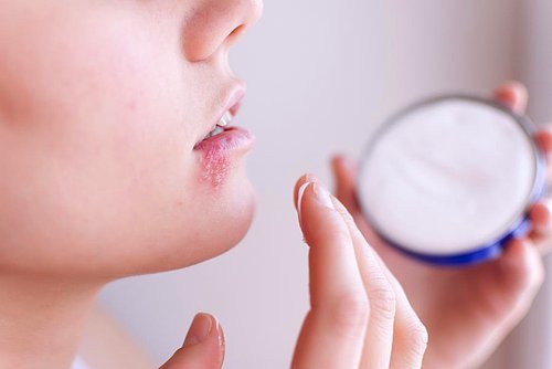 Uçuk neden olur? Uçuğun belirtileri nelerdir? 3 Uçuk neden olur? Uçuğun belirtileri nelerdir?