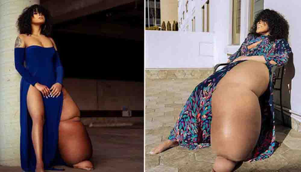 Bacaklarından biri 45 kilo olan lenfödemili kadın acımasız eleştirilere rağmen görünüşüyle barışık yaşıyor