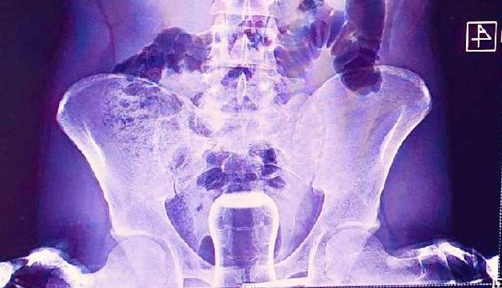 Basur-hastasının-hacamat-kazası--Çay-bardağı-ameliyatla-çıkarıldı!