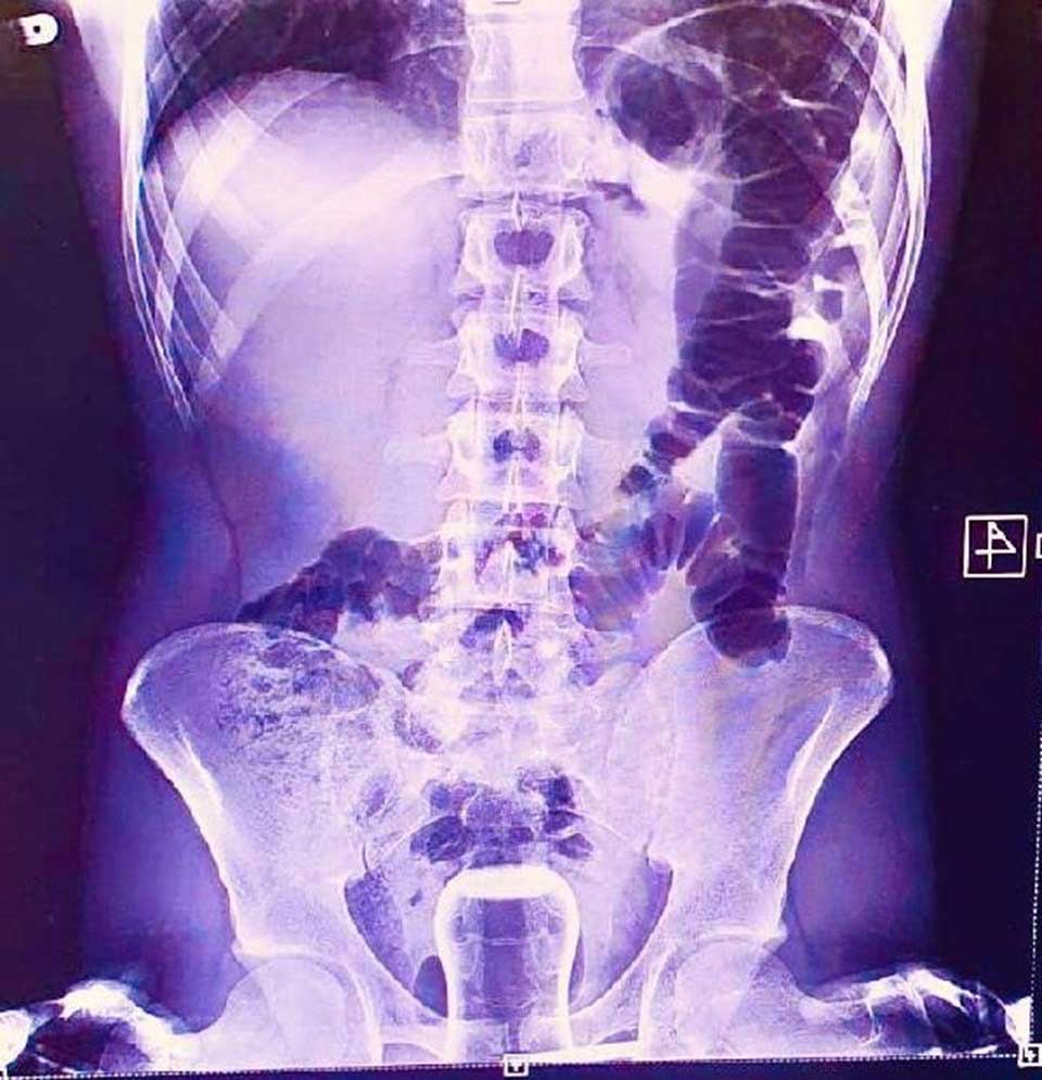 Basur hastasının hacamat kazası: Çay bardağı ameliyatla çıkarıldı!