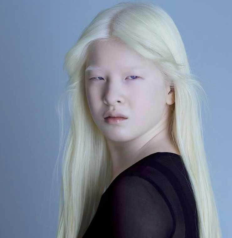 Bebekken görünüşü yüzünden terk edilmişti, Vogue modeli oldu