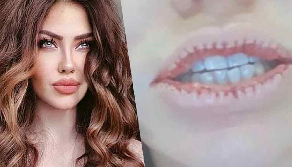 Dudaklarını küçülten Lara'dan estetik itirafı_ Sakın...