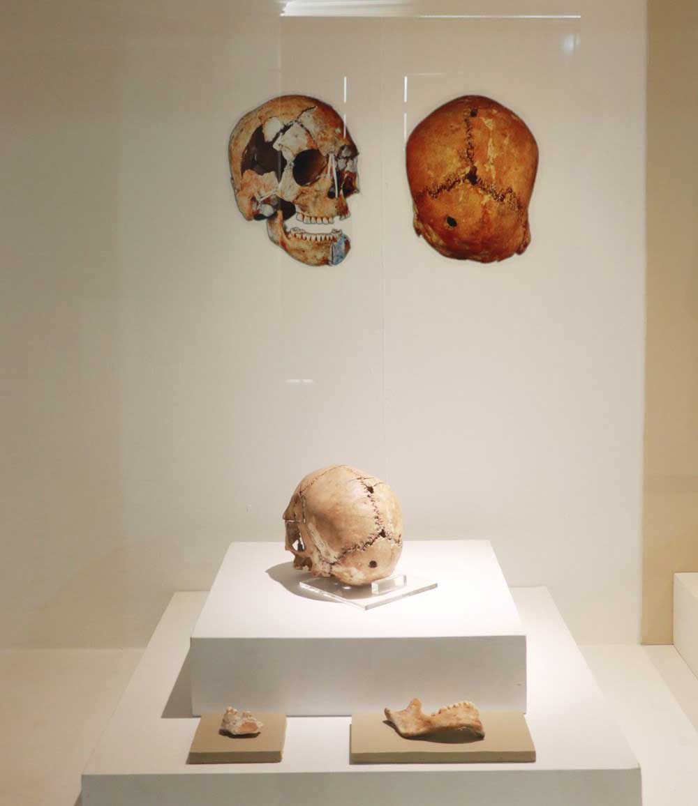 Dünyanın ilk beyin ameliyatının yapıldığı yer: Aşıklı Höyük