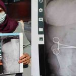 Karnında unutulan makasla iki ay yaşadı