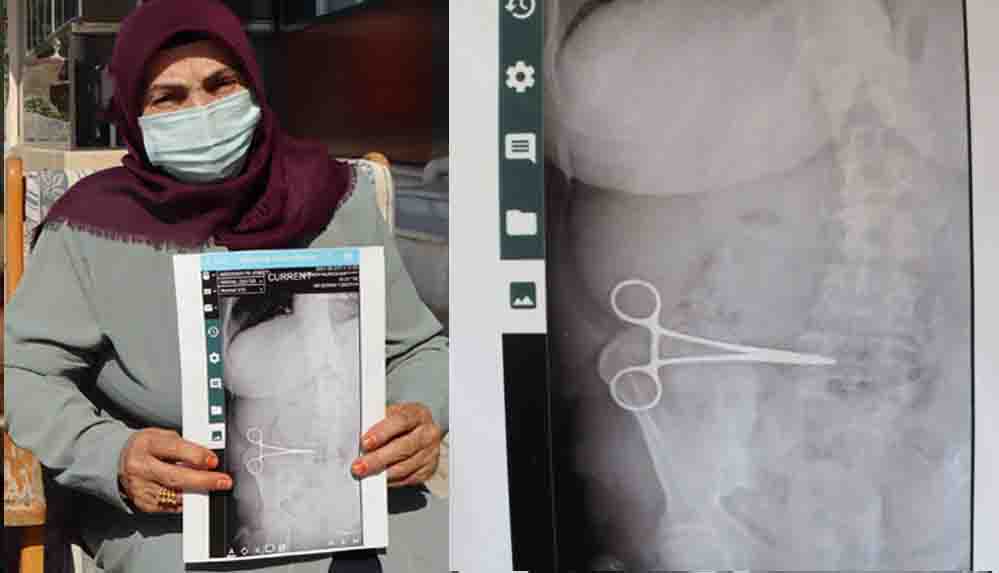 Karnında unutulan makasla iki ay yaşadı