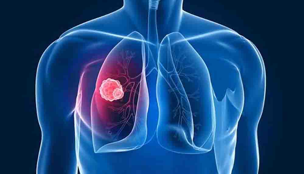 Akciğer kanserinin belirtileri nedir Akciğer kanseri nasıl anlaşılır