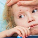 Kızamık nedir Kızamık kaç günde geçer Kızamık hastalığının belirtileri