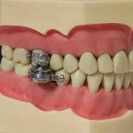 Obeziteyle mücadelede 'çene kilidi' 13 Obeziteyle mücadelede 'çene kilidi'