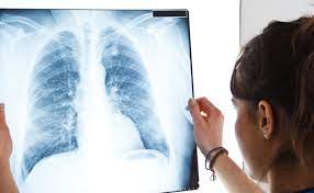 Akciğer kanserinin belirtileri nedir? Akciğer kanseri nasıl anlaşılır?