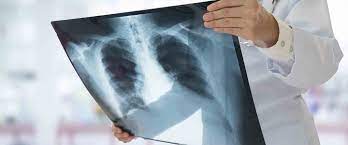 Zatürre (Pnömoni) nedir? Zatürre belirtileri nelerdir, tedavisi nasıl olmalı?