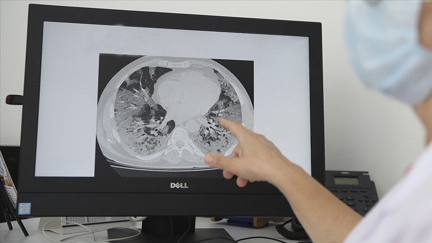 Zatürre (Pnömoni) nedir? Zatürre belirtileri nelerdir, tedavisi nasıl olmalı?