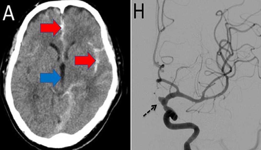 Günde-birkaç-kez-mastürbasyon-yapan-51-yaşındaki-adam-felç-geçirdi