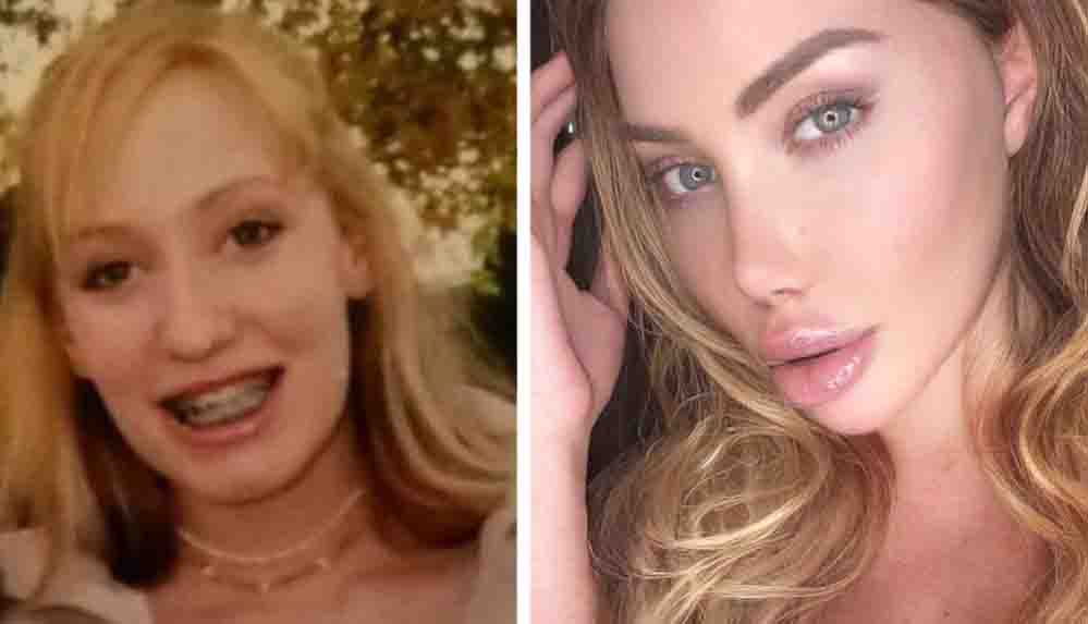 Estetikleri için 8 milyon lira harcadı Uyandığımda ağzım kanlar içindeydi