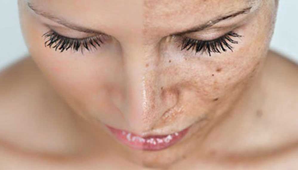 Güneş-Lekelerinin-Tedavisi-Mümkün