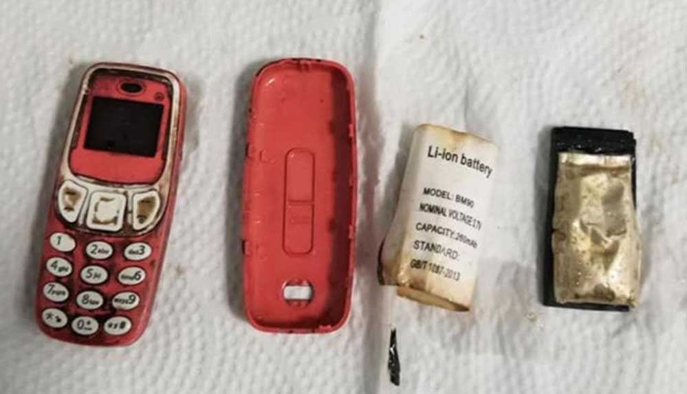 Kosova'da hastanın midesinden ameliyatla Nokia 3310 çıkarıldı