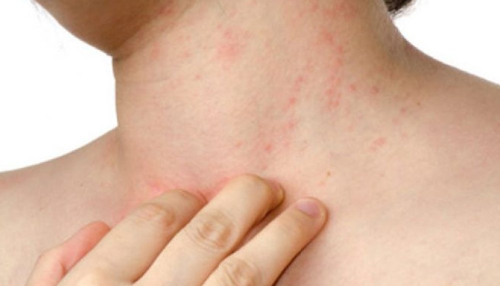 Türkiye’de yaklaşık 900 bin kronik ürtiker hastası olduğu tahmin ediliyor