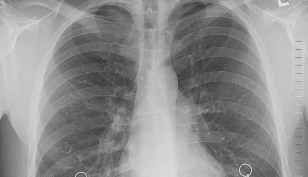 Türkiye'de-yılda-35-bin-kişi-akciğer-kanseri-tanısı-alıyor