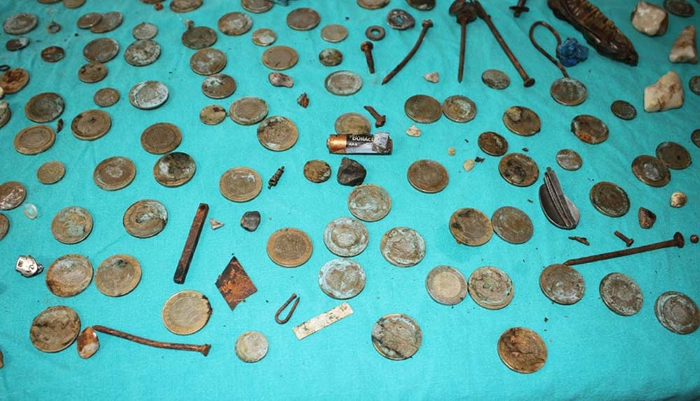 Midesinden 233 parça yabancı cisim çıkarılan hasta sağlığına kavuştu 4 Midesinden-233-parça-yabancı-cisim-çıkarılan-hasta-sağlığına-kavuştu