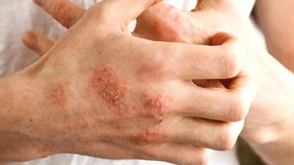 Uzmanlarından 'Egzama, besin alerjisi ile bağlantılı olabilir" tespiti