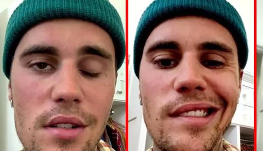 Yüz felci geçiren Justin Bieber, sağlık durumu hakkında konuştu