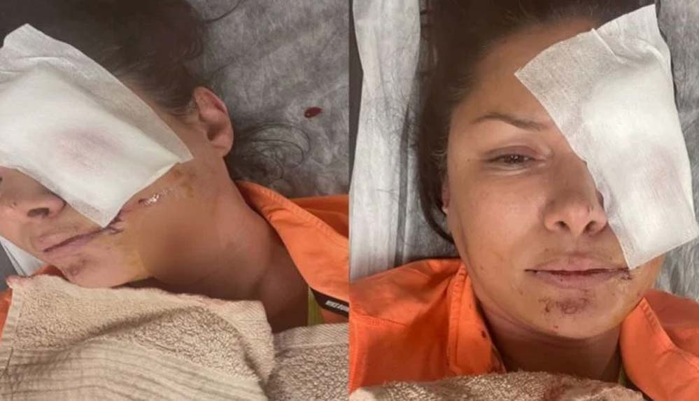 Şile'de-köpek-saldırısına-uğrayan-şarkıcı-Tuğba-Altıntop'un-yüzüne-dikiş-atıldı