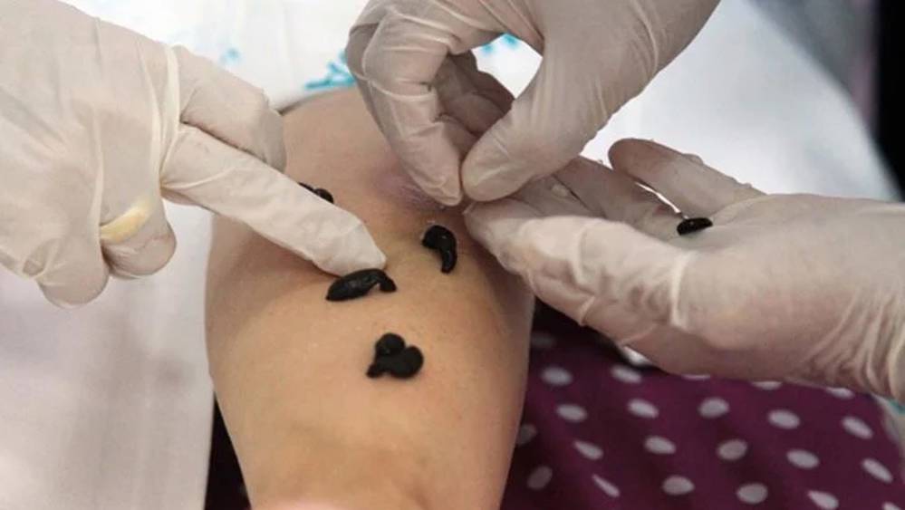 'Sülük tedavisi' uzman olmayan ellerde büyük riskler barındırıyor