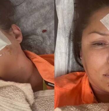 Şile'de-köpek-saldırısına-uğrayan-şarkıcı-Tuğba-Altıntop'un-yüzüne-dikiş-atıldı