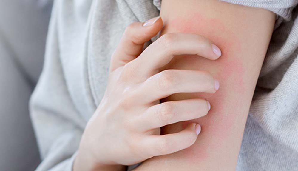 Uzmanı-uyardı--Gece-uyutmayan-kaşıntıların-nedeni-uyuz-hastalığı-olabilir