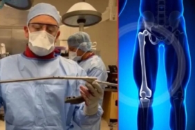 Uzman doktor paylaştı: Ameliyatla boy nasıl uzatılıyor? 4 Ameliyatla boy nasıl uzatılıyor